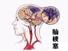 養(yǎng)成好的生活習慣，能夠有效預防腦梗塞